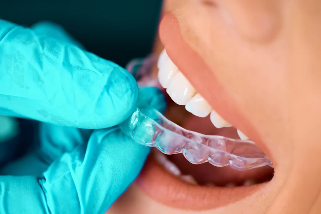 Durchsichtige Aligner-Schiene wird eingesetzt